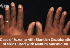 Eczema with Blackish Discoloration