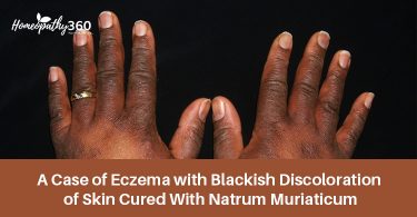 Eczema with Blackish Discoloration
