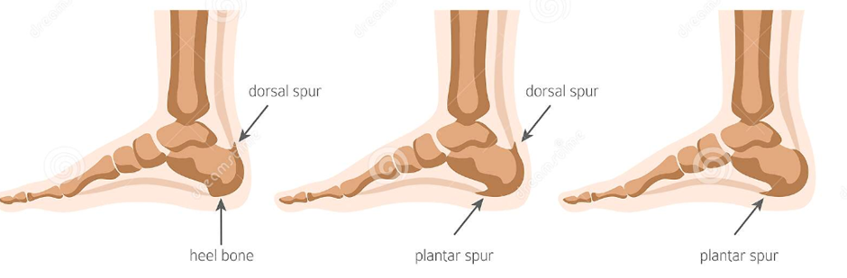 A Narrative Review of Calcaneal Enthesophytes And Homoeopathy