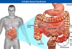 Irritable Bowel Syndrome