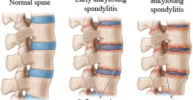 Ankylosing Spondylosis