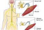motor neuron disease