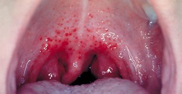 Streptococcal infection, throat