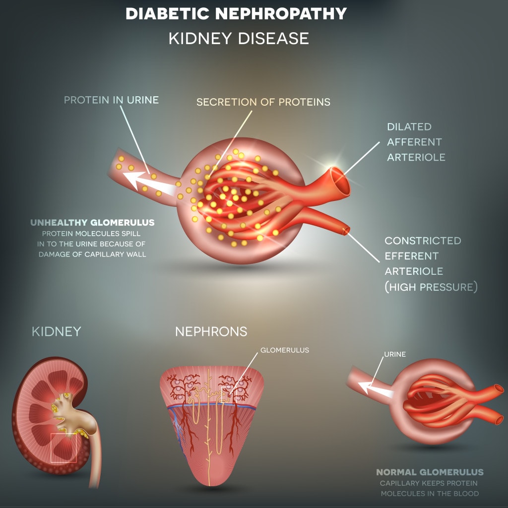 diabetic nephropathy treatment in homeopathy