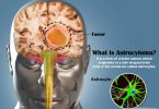 ASTROCYTOMA