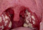 acute tonsillitis