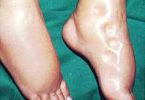 pedal oedema