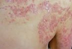 psoriasis