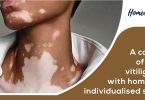vitiligo treated with homoeopathic