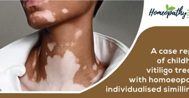 vitiligo treated with homoeopathic
