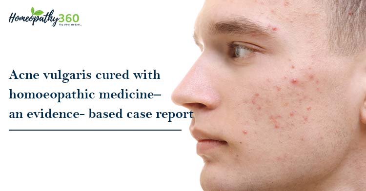 Therapeutic approach of Tinea Corporis - homeopathy360