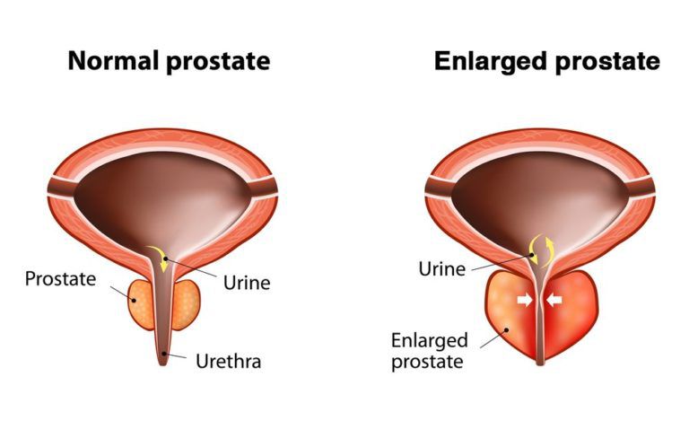 A prostatitis homeopátiás kezelése