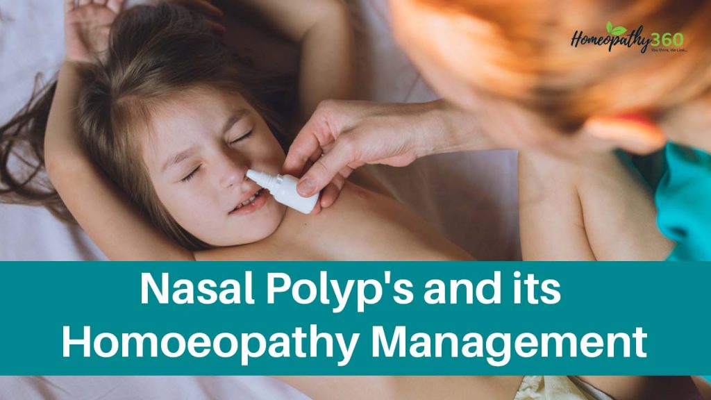 Nasal Polyp's and its Homoeopathy Management