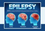 epliepsy