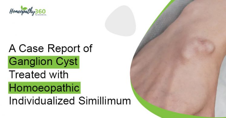 A Case Report of Ganglion Cyst Treated With Homoeopathic Individualised Simillimum