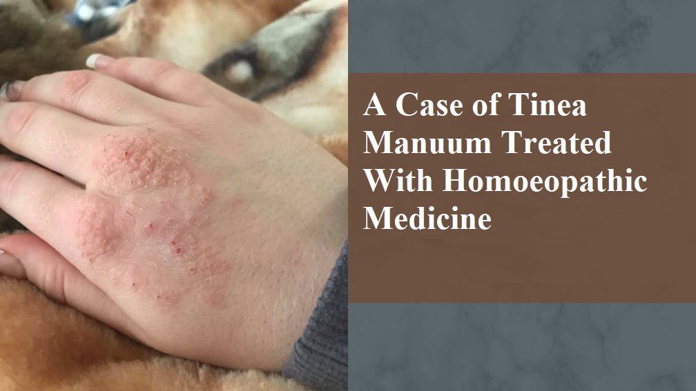 A Case of Tinea Manuum Treated With Homoeopathic Medicine - Dr Sasmita Padhi