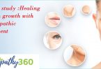 A clinical case: Healing of skin growth with homeopathic remedy or treatment