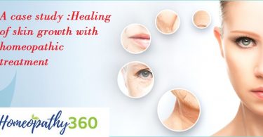 A clinical case: Healing of skin growth with homeopathic remedy or treatment