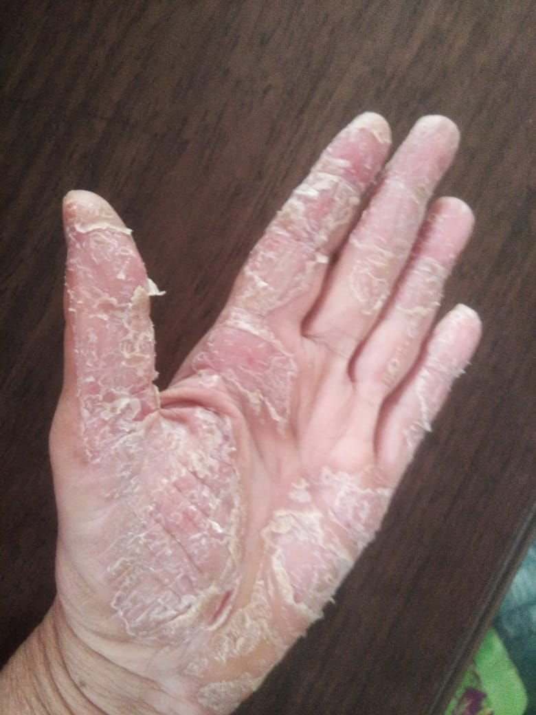 palmoplantar psoriasis in child vörös napfoltok a kezeken