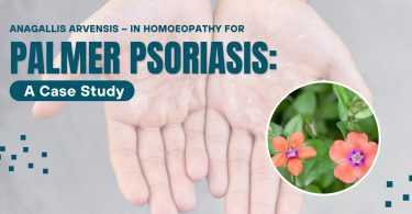 Palmer Psoriasis