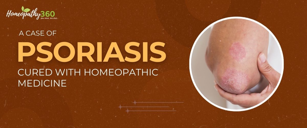 A Case of Psoriasis Cured with Homeopathic Medicine