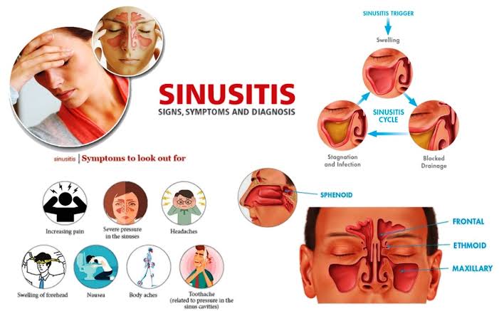 QUIXX Sinupret Coated Tablets (Alleviate Symptoms Of Acute And Chronic  Inflammation Of The Paranasal Sinuses) 50s, Ear, Nose & Throat Care