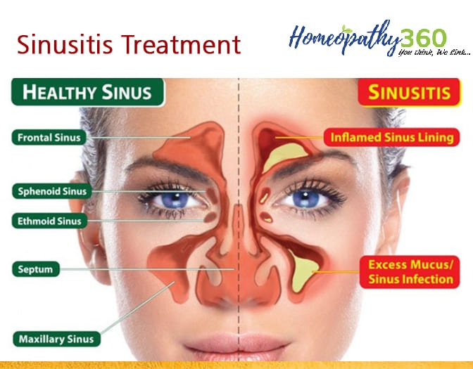 Sinus Infection (Sinusitis): Types, Causes, Symptoms with homeopathy.