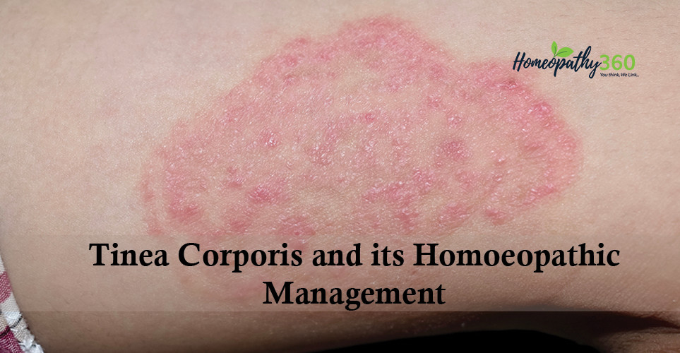 Therapeutic approach of Tinea Corporis - homeopathy360