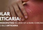 Urticaria