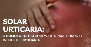 Urticaria