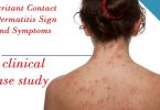 Contact-Dermatitis