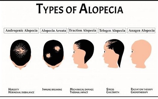 Alopecia Areata: Causes, Symptoms and Treatment with Homeopathic Medicine