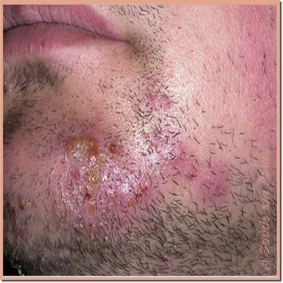 tinea cruris, tinea infection treatment, types of tinea