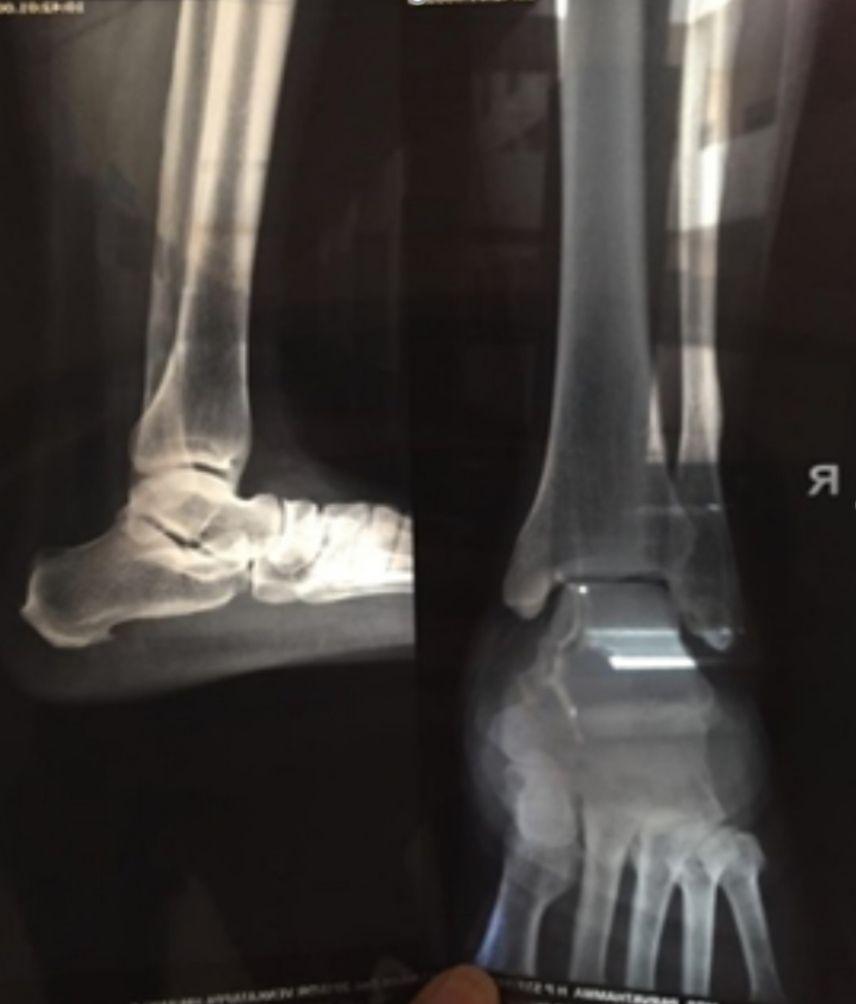 calcaneal spur xray