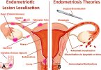 endometriosis