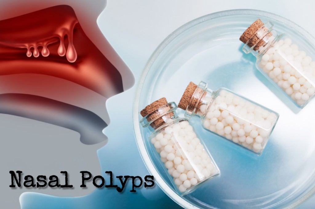 Home nose remedy polyps Nasal Polyps