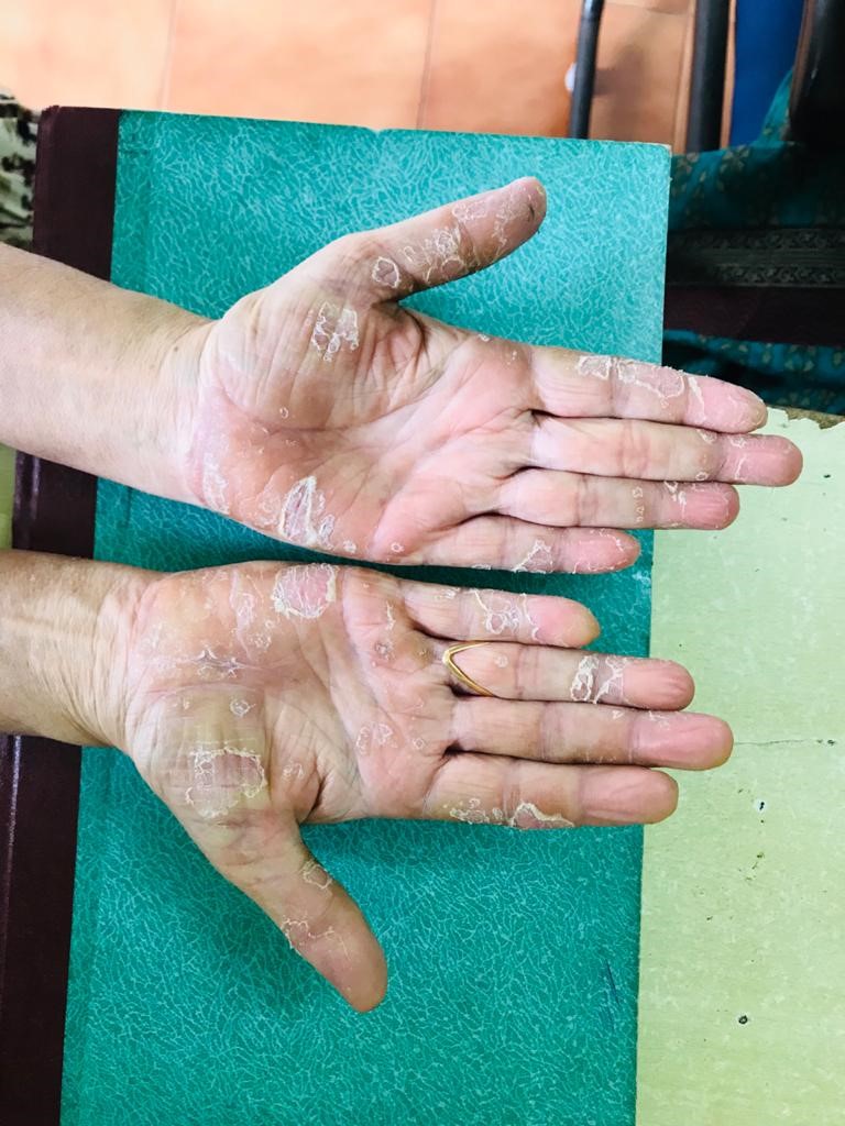 Palmoplantar psoriasis Causes, symptoms and treatment with homeopathy