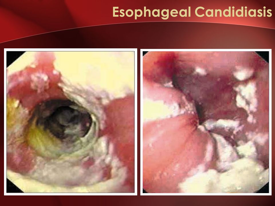 Oesophageal Candidiasis