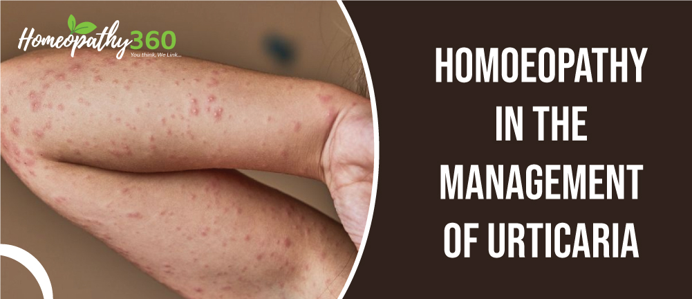 Hives Urticaria Causes Pictures Symptoms And Treatment With